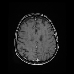 Balo concentric sclerosis (Radiopaedia 53875-59982 Axial LAVA C+ 179).jpg