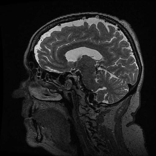 Balo concentric sclerosis (Radiopaedia 53875-59982 Sagittal 3D FSE 124).jpg