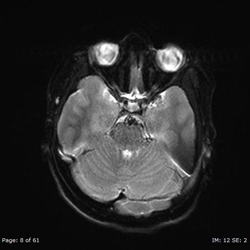 Balo concentric sclerosis (Radiopaedia 61637-69636 Axial DWI 8).jpg