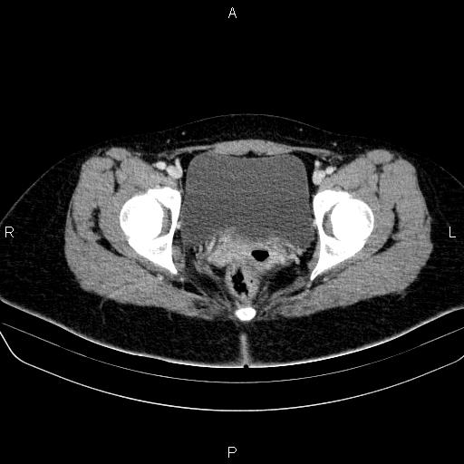File:Bartholin gland cyst (Radiopaedia 62635-70930 Axial Post contrast 64).jpg
