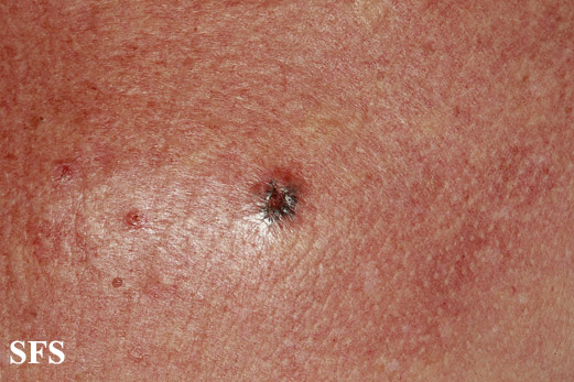 Basal Cell Carcinoma (Dermatology Atlas 252).jpg