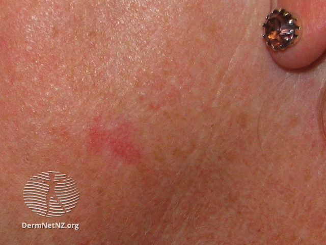 Basal cell carcinoma affecting the face (DermNet NZ lesions-bcc-face-0712).jpg