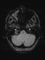Base of skull chondrosarcoma (Radiopaedia 30410-31070 Axial SWI 9).jpg