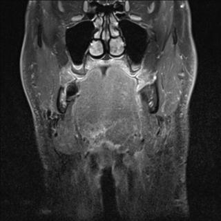 File:Base of tongue squamous cell carcinoma (Radiopaedia 31174-31884 E 12).jpg