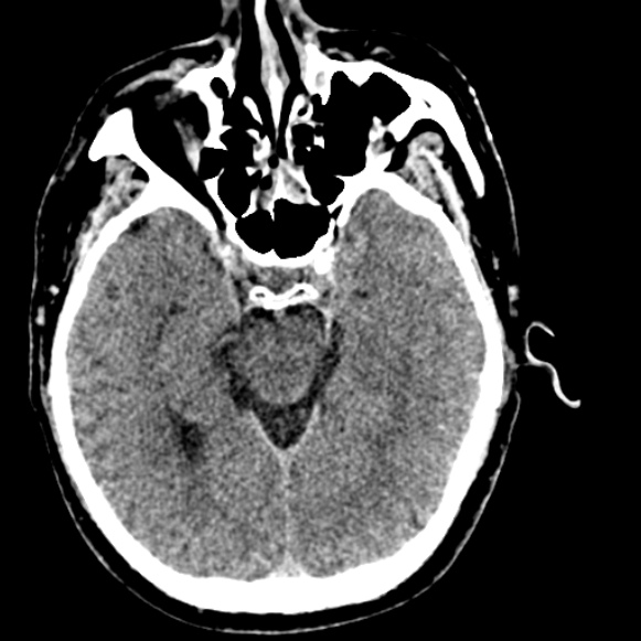 Basilar artery thrombosis (Radiopaedia 53351-59333 Axial non-contrast 53).jpg