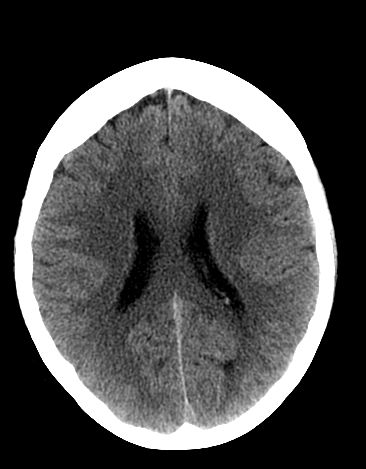 File:Basilar tip aneurysm with coiling (Radiopaedia 53912-60033 Axial non-contrast 17).jpg