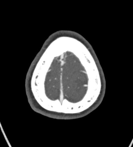 Basilar tip aneurysm with coiling (Radiopaedia 53912-60086 A 139).jpg
