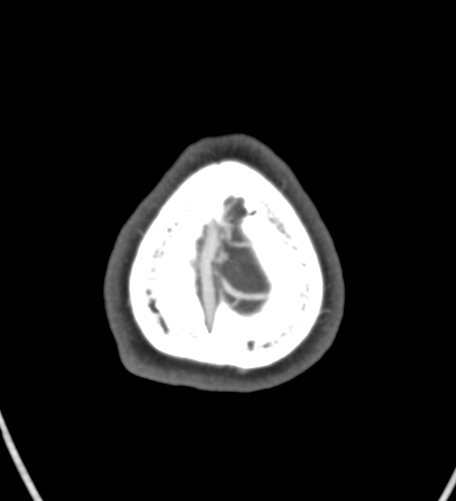 Basilar tip aneurysm with coiling (Radiopaedia 53912-60086 A 145).jpg