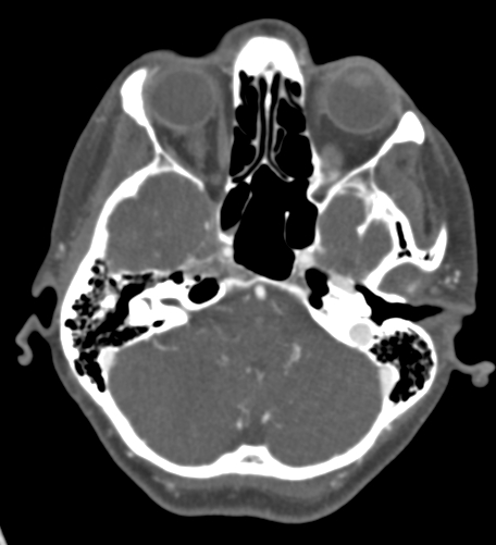 File:Basilar tip aneurysm with coiling (Radiopaedia 53912-60086 A 37).jpg