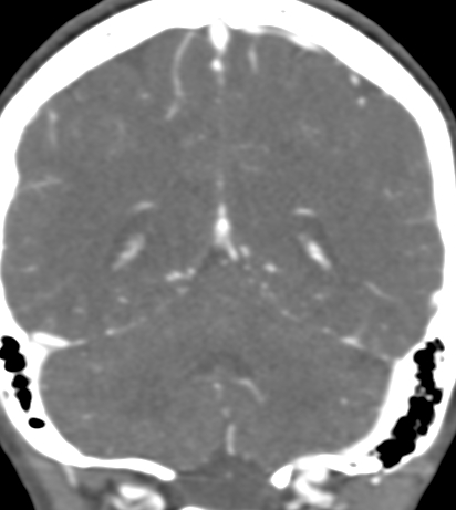 Basilar tip aneurysm with coiling (Radiopaedia 53912-60086 B 112).jpg