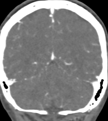 Basilar tip aneurysm with coiling (Radiopaedia 53912-60086 B 119).jpg