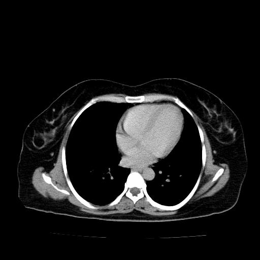 File:Benign spindle cell tumor - abdominopelvic (Radiopaedia 61300-69212 Axial C+ delayed 3).jpg