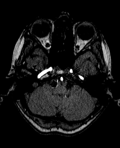 File:Berry aneurysm of the terminal internal carotid artery (Radiopaedia 88286-104918 Axial TOF 68).jpg