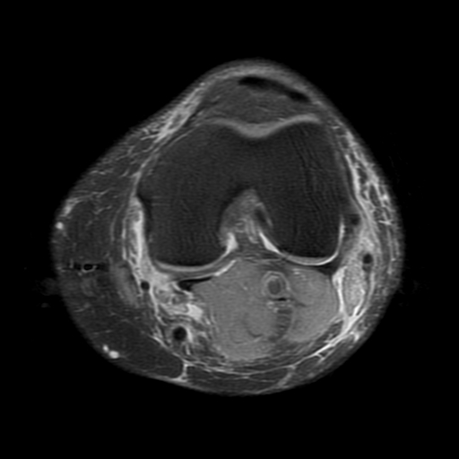 File:Biceps femoris distal tendon avulsion (Radiopaedia 15109-14987 Axial PD fat sat 12).jpg