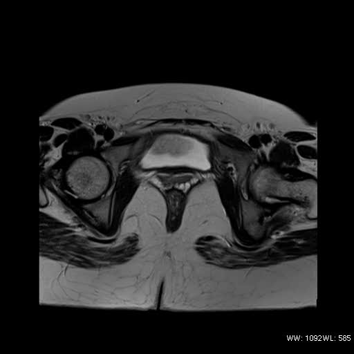 File:Bicornuate uterus- on MRI (Radiopaedia 49206-54297 Axial T2 14).jpg