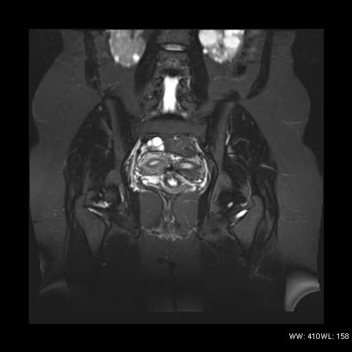 File:Bicornuate uterus- on MRI (Radiopaedia 49206-54297 Coronal STIR 12).jpg
