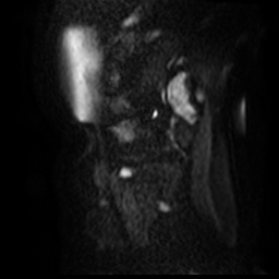 File:Bicornuate uterus (Radiopaedia 51676-57472 Sagittal DWI 32).jpg