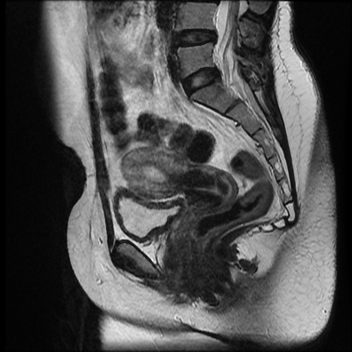 File:Bicornuate uterus (Radiopaedia 51676-57472 Sagittal T2 15).jpg