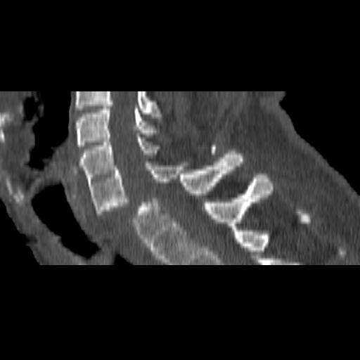 File:Bilateral C6-7 locked facet dislocation (Radiopaedia 28506-28748 Sagittal bone window 10).jpeg