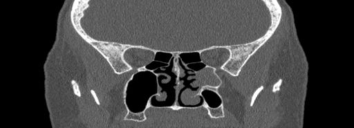 Bilateral Ectopic Infraorbital Nerves (Radiopaedia 49006-54084 Coronal bone window 52).jpg