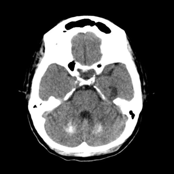 File:Bilateral PCA territory infarction - different ages (Radiopaedia 46200-50591 Axial non-contrast 6).jpg