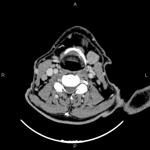 Bilateral Warthin tumors (Radiopaedia 84034-99263 Axial With contrast 40).jpg