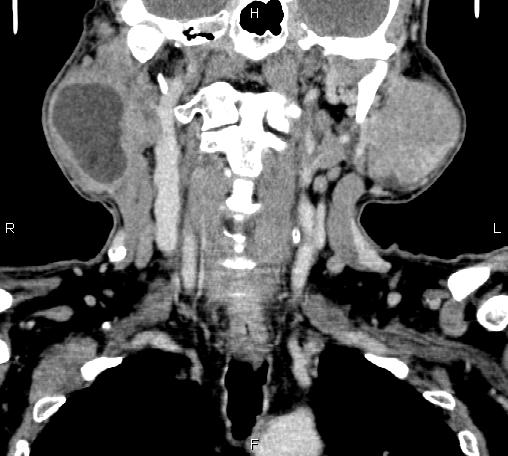 File:Bilateral Warthin tumors (Radiopaedia 84034-99263 C 28).jpg