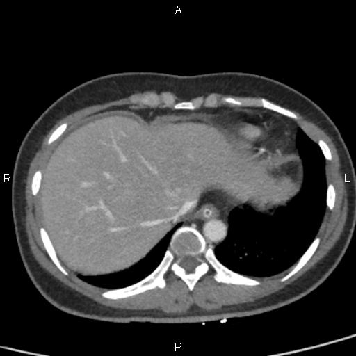 Bilateral adrenal gland hyperenhancement in pancreatitis (Radiopaedia 86642-102753 E 11).jpg