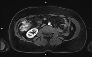 File:Bilateral adrenal myelolipoma (Radiopaedia 63058-71537 Axial T1 C+ fat sat 61).jpg
