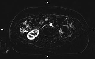 Bilateral adrenal myelolipoma (Radiopaedia 63058-71537 I 61).jpg