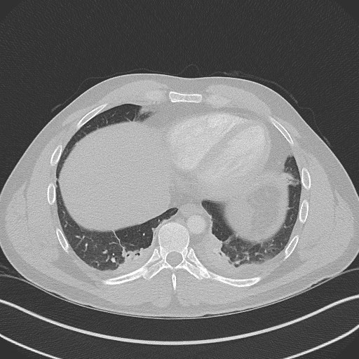 Bilateral atelectasis (Radiopaedia 48666-53675 Axial lung window 86).jpg