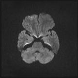 Bilateral basal ganglia and thalamic T1 hyperintensities (Radiopaedia 19764-19802 Axial DWI 25).jpg