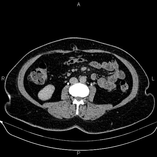 Bilateral benign adrenal adenomas (Radiopaedia 86912-103124 Axial C+ delayed 82).jpg