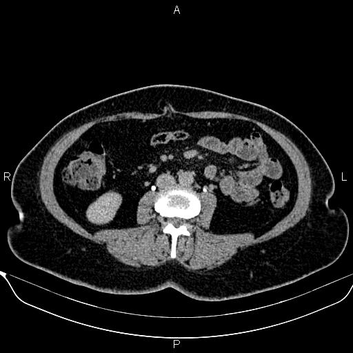 Bilateral benign adrenal adenomas (Radiopaedia 86912-103124 Axial C+ delayed 83).jpg