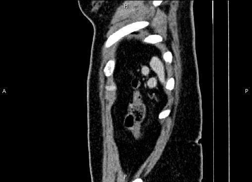 Bilateral benign adrenal adenomas (Radiopaedia 86912-103124 E 94).jpg
