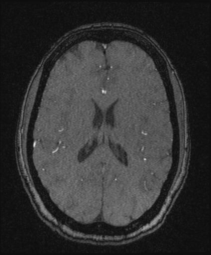 Bilateral carotid body tumors and right glomus jugulare tumor (Radiopaedia 20024-20060 Axial MRA 114).jpg