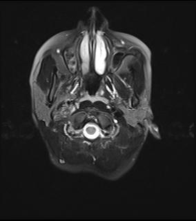 File:Bilateral carotid body tumors and right jugular paraganglioma (Radiopaedia 20024-20060 Axial 32).jpg
