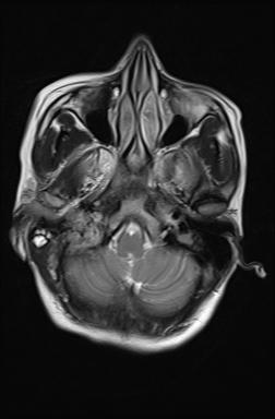 File:Bilateral carotid body tumors and right jugular paraganglioma (Radiopaedia 20024-20060 Axial 61).jpg