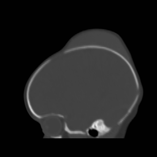 File:Bilateral cephalohematomas and subdural hematomas (Radiopaedia 26778-26929 Sagittal bone window 12).jpg