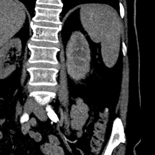 File:Bilateral delayed nephrogram from renal artery stenosis (Radiopaedia 47681-52362 B 18).png