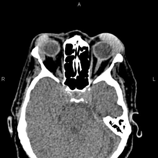 Bilateral enlargement of lacrimal glands - sarcoidosis (Radiopaedia 62627-70921 Axial non-contrast 48).jpg