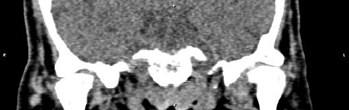 File:Bilateral enlargement of lacrimal glands - sarcoidosis (Radiopaedia 62627-70921 Coronal non-contrast 30).jpg