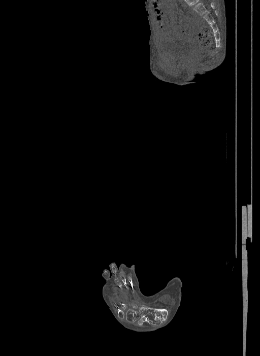 Bilateral fibular hemimelia type II (Radiopaedia 69581-79491 Sagittal bone window 47).jpg