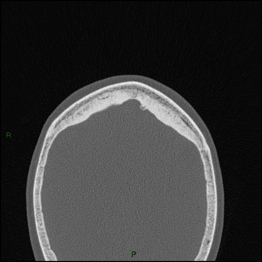 Bilateral frontal mucoceles (Radiopaedia 82352-96454 Axial bone window 4).jpg