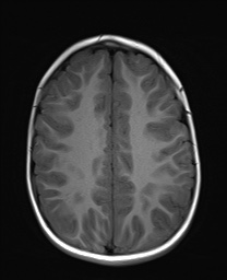 File:Bilateral mesial temporal polymicrogyria (Radiopaedia 76456-88181 Axial T1 18).jpg