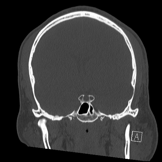 Bilateral occipital condyle fracture (type 2) (Radiopaedia 87675-104089 Coronal bone window 56).jpg