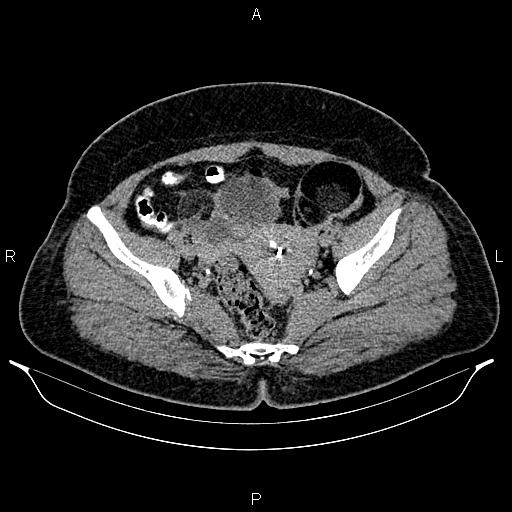 Bilateral ovarian dermoid cysts (Radiopaedia 85785-101603 Axial C+ delayed 69).jpg