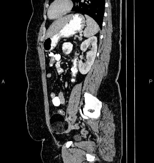 File:Bilateral ovarian dermoid cysts (Radiopaedia 85785-101603 D 65).jpg