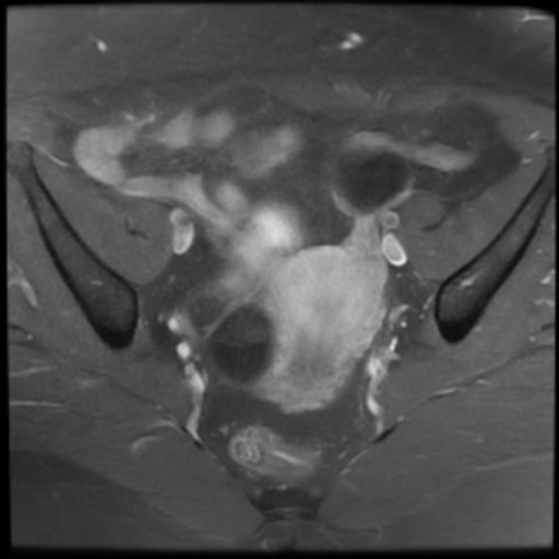 File:Bilateral ovarian dermoid cysts (Radiopaedia 90152-107338 Axial T1 C+ fat sat 10).jpg