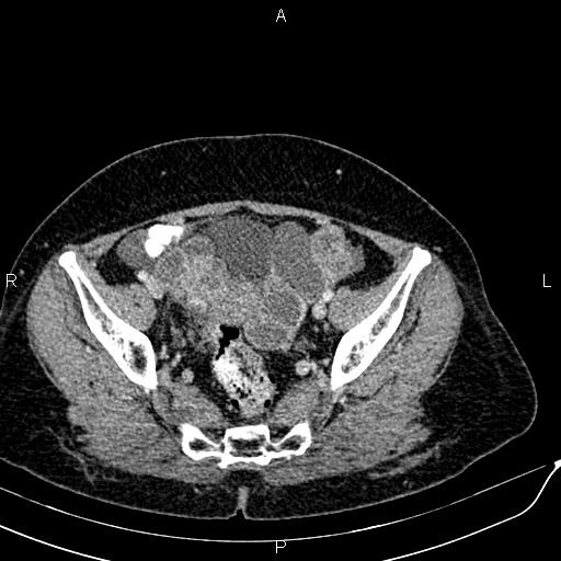 Bilateral ovarian serous cystadenocarcinoma (Radiopaedia 86062-101989 B 85).jpg